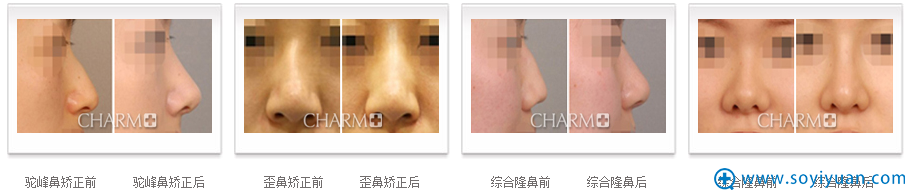 重庆当代鼻部整形案例 重庆当代鼻部整形案例