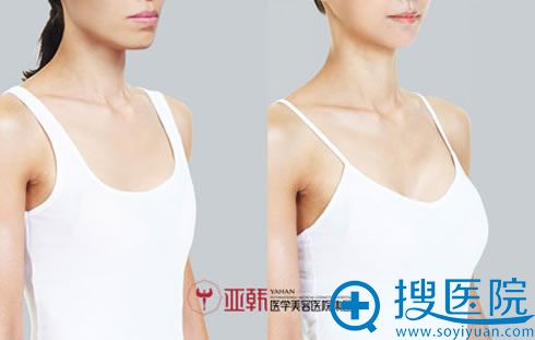 长沙亚韩美容隆胸效果对比图 长沙亚韩美容隆胸效果对比图