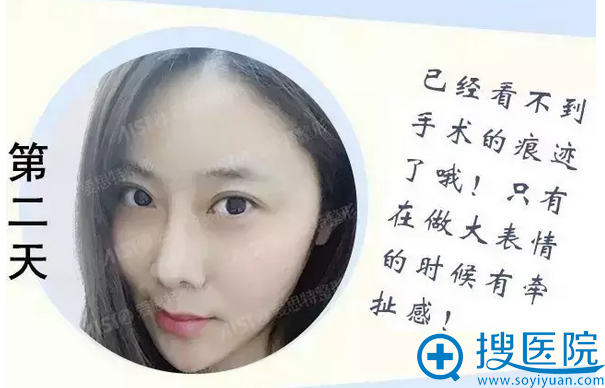 面部线雕第二天效果 面部线雕第二天效果