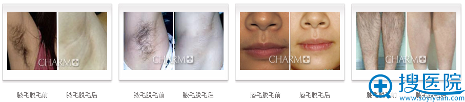 重庆当代脱毛案例 重庆当代脱毛案例
