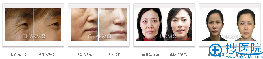 重庆当代除皱案例 重庆当代除皱案例
