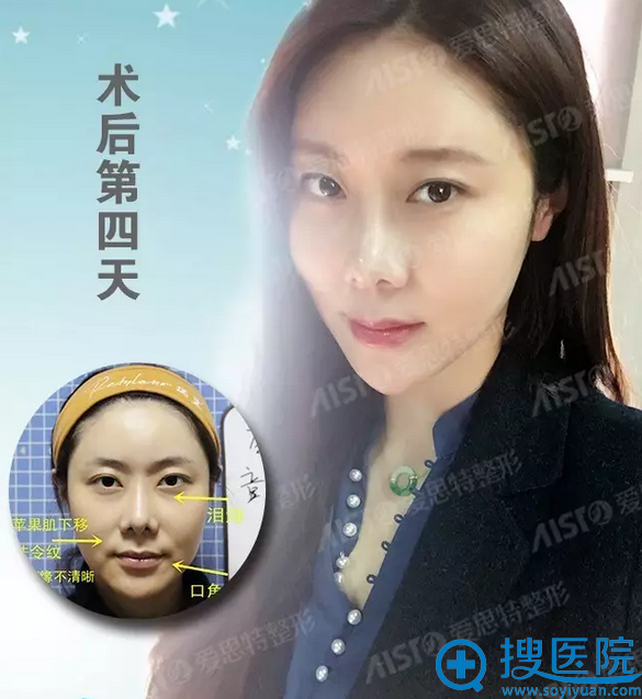面部线雕术后第四天效果 面部线雕术后第四天效果