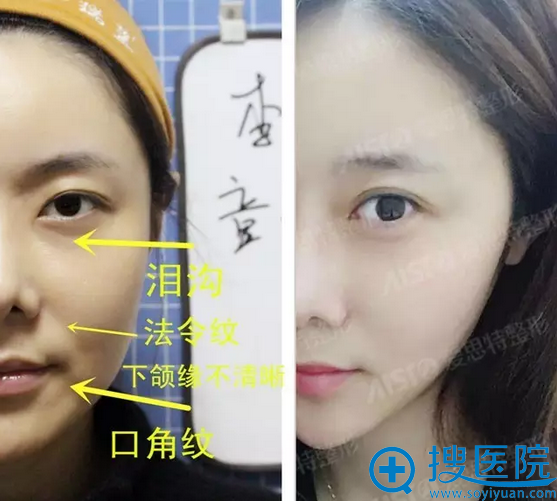 杨定宇面部线雕术效果前后对比 杨定宇面部线雕术效果前后对比