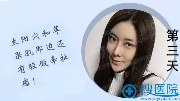 面部线雕第三天效果 面部线雕第三天效果