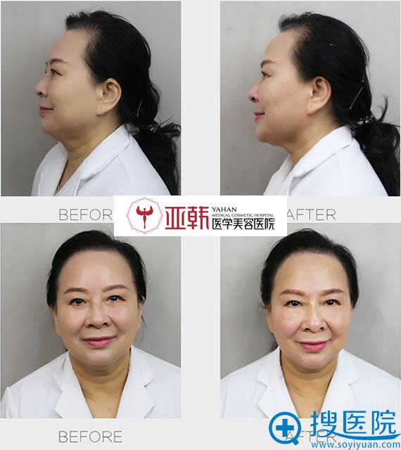 亚韩院长体验玻尿酸隆鼻效果对比图 亚韩院长体验玻尿酸隆鼻效果对比图
