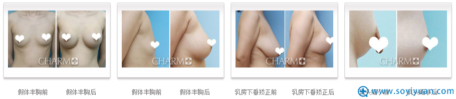 重庆当代胸部整形案例 重庆当代胸部整形案例