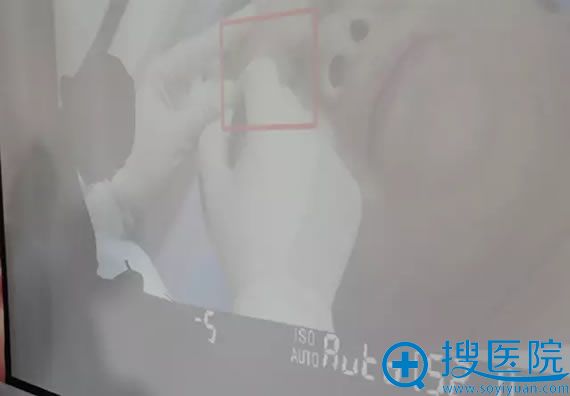 长沙亚韩整形段曼利院长亲自体验玻尿酸注射隆鼻 长沙亚韩整形段曼利院长亲自体验玻尿酸注射隆鼻