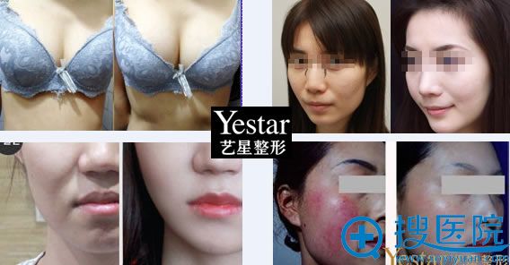 昆明艺星整形医院案例对比图 昆明艺星整形医院案例对比图