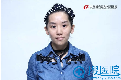 琳娜术前照片 琳娜术前照片