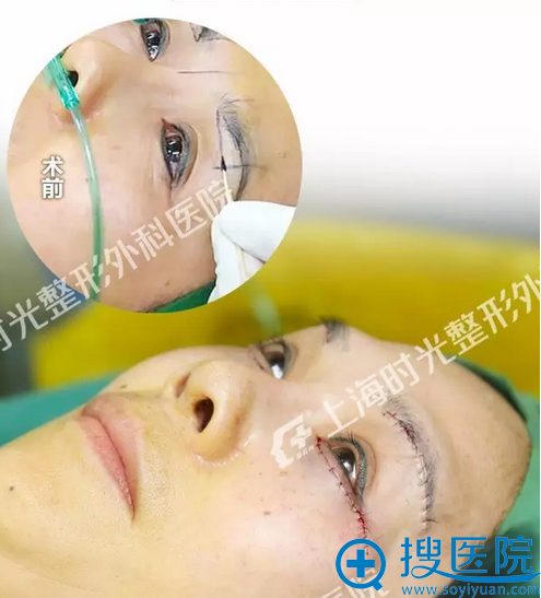母亲手术即刻效果 母亲手术即刻效果