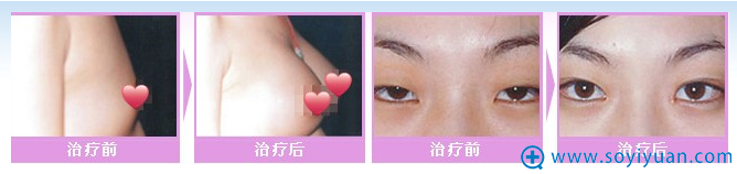 <!--<i data=20240710 data-id=14088></i>-->整形医院双眼皮案例 <!--<i data=20240710 data-id=14088></i>-->整形医院双眼皮案例