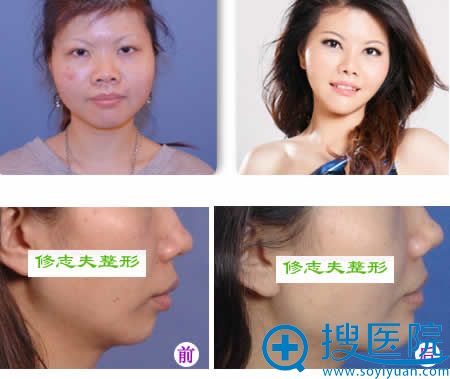 厦门修志夫整形美容医院案例图 厦门修志夫整形美容医院案例图