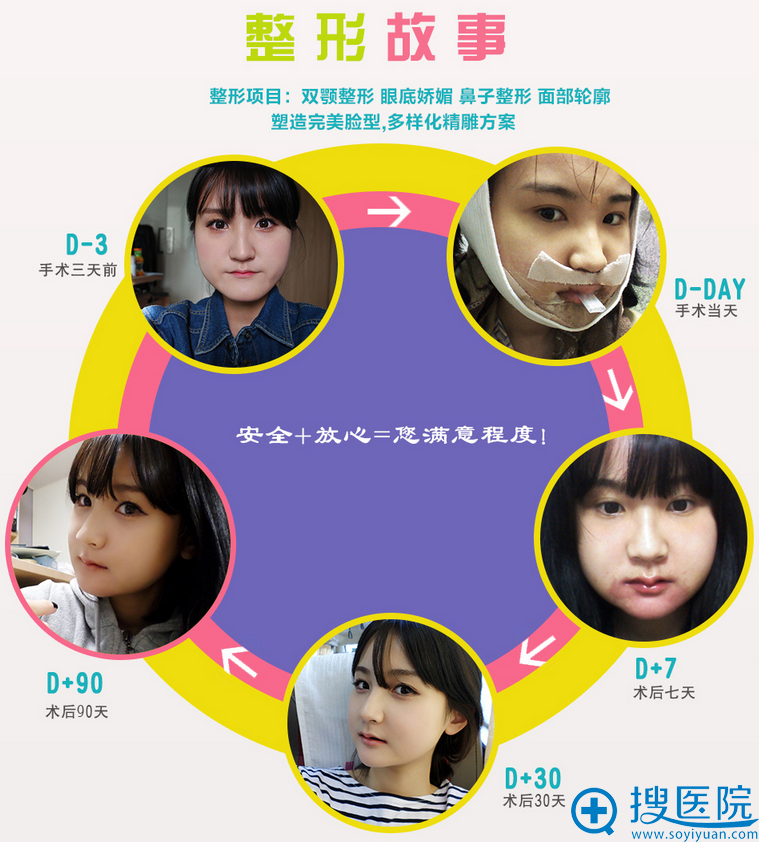 韩国原辰整形医院双鄂(两鄂)整形效果怎么样 看了案例就知道