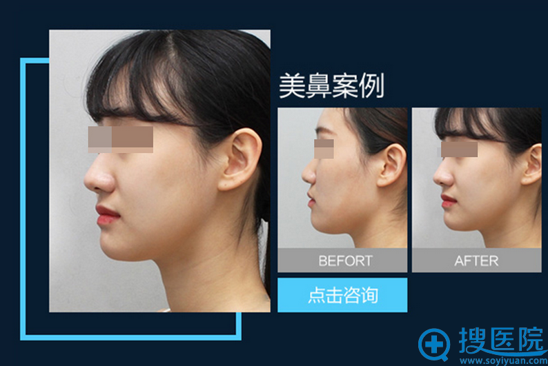 <!--<i data=20240710 data-id=12266></i>-->厉建华主任假体隆鼻前后对比 <!--<i data=20240710 data-id=12266></i>-->厉建华主任假体隆鼻前后对比