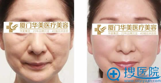 厦门华美整形面部注射玻尿酸效果图 厦门华美整形面部注射玻尿酸效果图