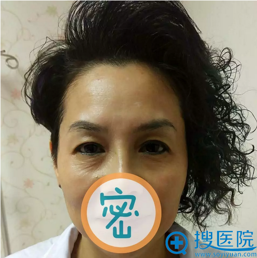 琳娜母亲术前照片 琳娜母亲术前照片