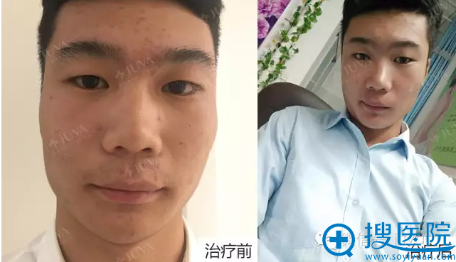<!--<i data=20240710 data-id=13204></i>-->男生去痘痘术前术后效果对比 <!--<i data=20240710 data-id=13204></i>-->男生去痘痘术前术后效果对比
