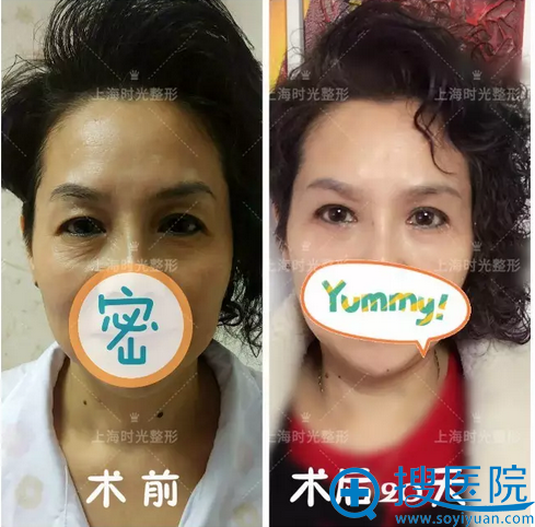 手术20天恢复效果 手术20天恢复效果
