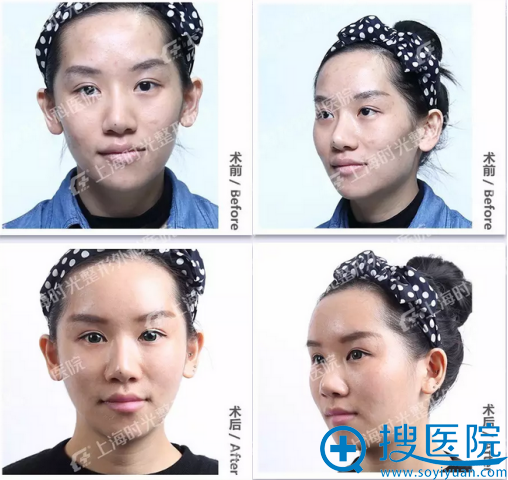 自体脂肪填充手术前后对比 自体脂肪填充手术前后对比