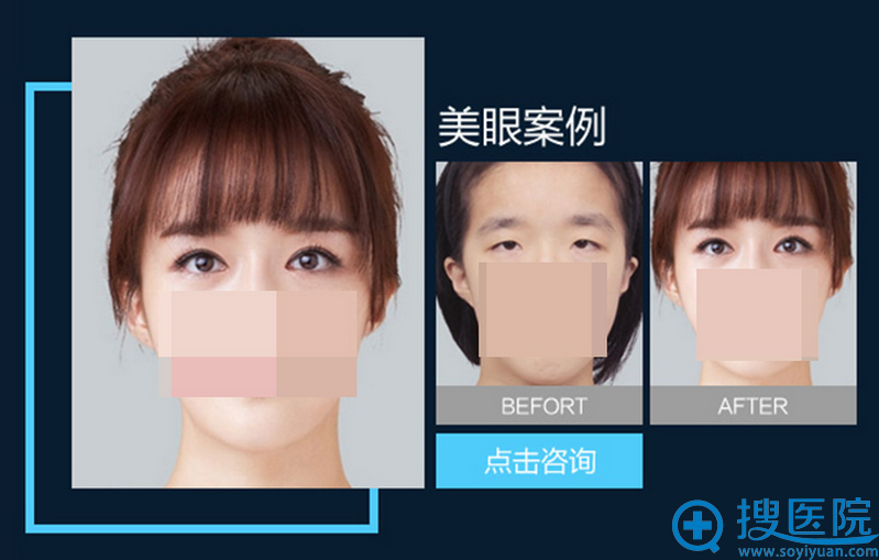<!--<i data=20240710 data-id=12266></i>-->厉建华主任双眼皮前后对比 <!--<i data=20240710 data-id=12266></i>-->厉建华主任双眼皮前后对比