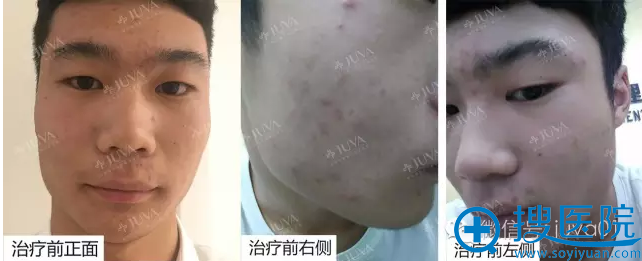 北京欧华男生去痘痘案例 祛痘不只是女性的专属
