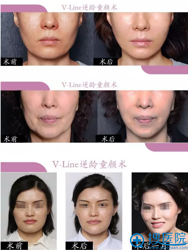 V-Line逆龄童颜术前后对比图片 V-Line逆龄童颜术前后对比图片