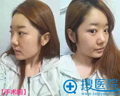 【真实经历】在韩国id整形医院做V-line下颌角+鼻部修复手术2年