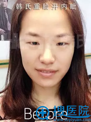 【真实经历】看我去济南韩氏找郭广科做双眼皮5个月恢复怎么样
