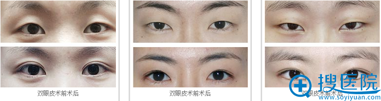 464整形医院双眼皮对比案例 464整形医院双眼皮对比案例