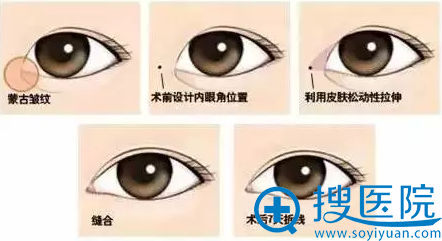 双眼皮案例:内眦赘皮切除 双眼皮案例:内眦赘皮切除