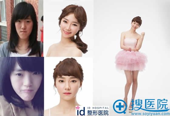 韩国ID整形为let美人郭芳媛手术照片 韩国ID整形为let美人郭芳媛手术照片