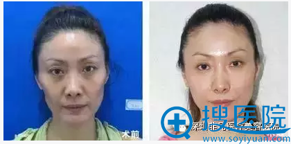 魏嘉宏微整形案例 魏嘉宏微整形案例