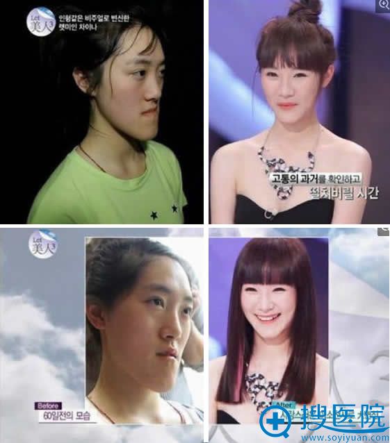 let美人郭芳媛整形前后效果对比 let美人郭芳媛整形前后效果对比