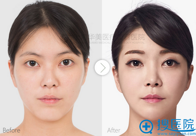 上海华美鼻综合+v-line真人对比图 上海华美鼻综合+v-line真人对比图