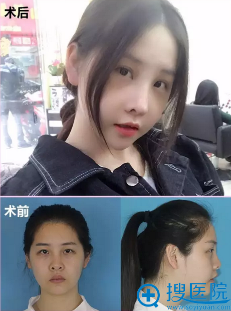 【恢复日记】看我在南宁华美整形医院做膨体隆鼻1-7天恢复过程