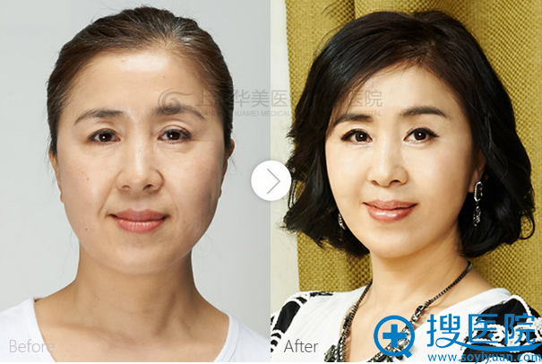 上海华美面部年轻化案例 上海华美面部年轻化案例
