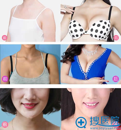 佛山曙光金子整形医院案例图 佛山曙光金子整形医院案例图