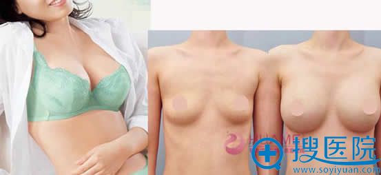 厦门华美整形隆胸前后效果对比 厦门华美整形隆胸前后效果对比
