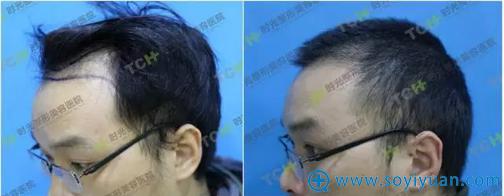 进入术后置换期 进入术后置换期