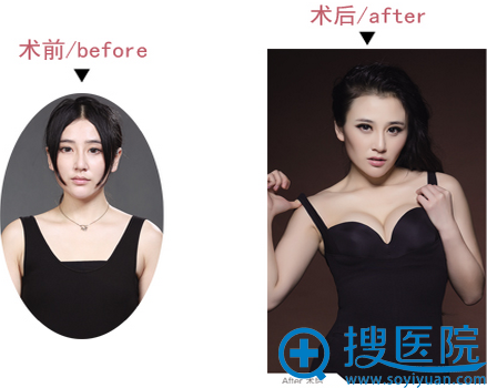 昆明梦想整形医院假体隆胸前后对比 昆明梦想整形医院假体隆胸前后对比