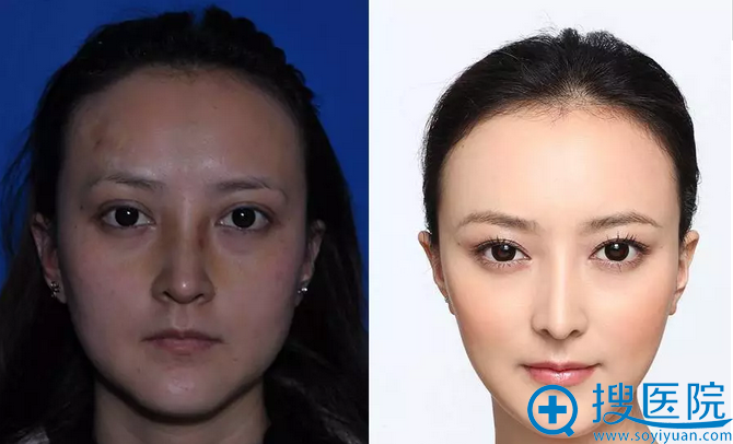邱叶柳馨整形前后效果对比 邱叶柳馨整形前后效果对比