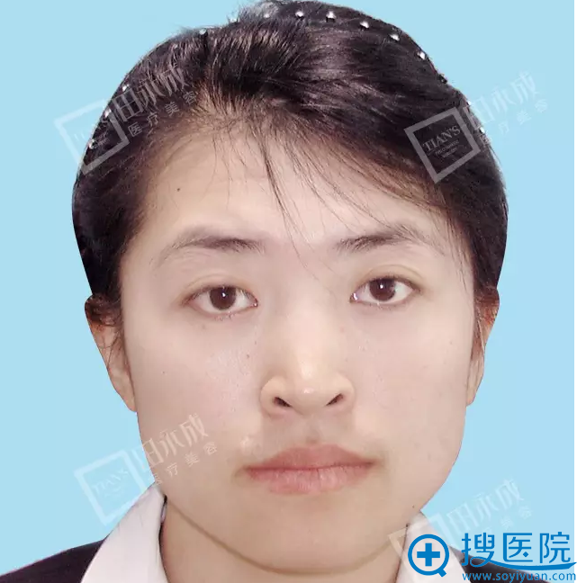 田永成整形BTS瘦脸真人案例 大饼脸秒变小V脸