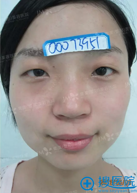 【视频】分享一个在郑州集美花2800元做双眼皮妹子的亲身经历