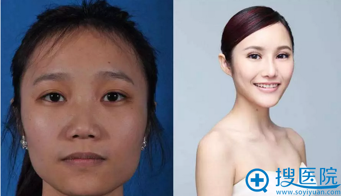 杨佳宜整形前后效果对比 杨佳宜整形前后效果对比