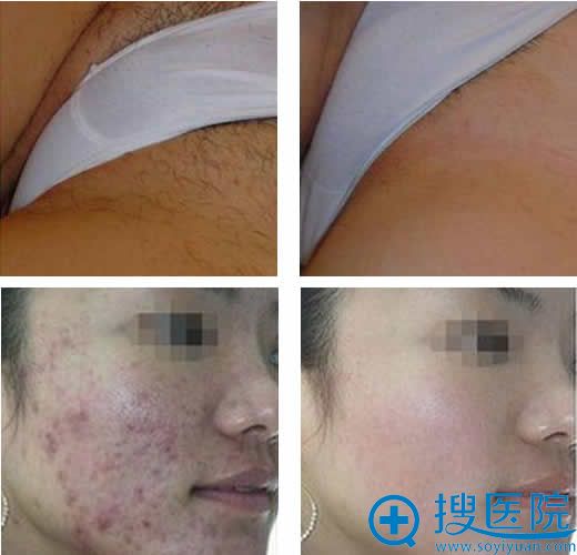 南京施尔美整形医院脱毛及祛痘案例 南京施尔美整形医院脱毛及祛痘案例