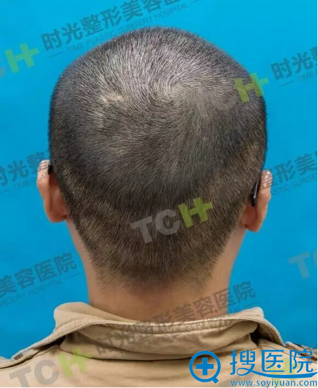 后枕取发区域恢复情况 后枕取发区域恢复情况