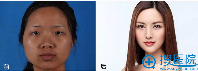 刘奕歌整形前后案例对比 刘奕歌整形前后案例对比