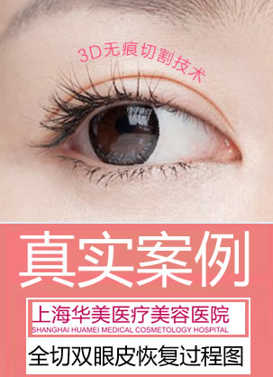 【经历】找上海华美许再荣做全切双眼皮恢复过程图 7个月记实