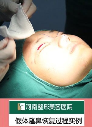 假体隆鼻恢复过程实例 河南整形医院支凌翔主任鼻整形案例