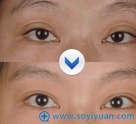 韩国BIO曹仁昌双眼皮过深修复案例 韩国BIO曹仁昌双眼皮过深修复案例